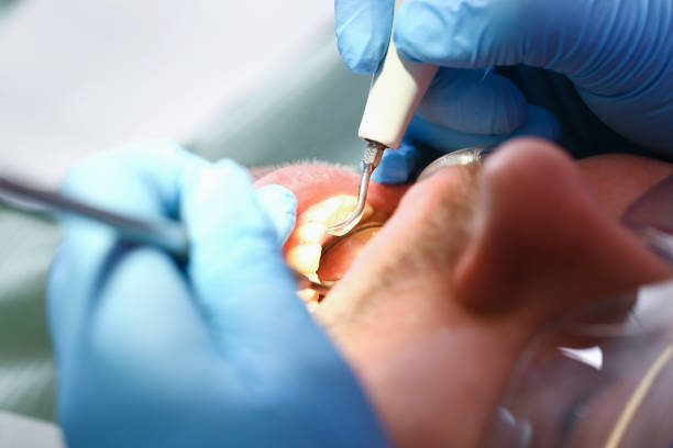 Best Emergency Dentist for Knocked-Out Tooth in Wilson, OK